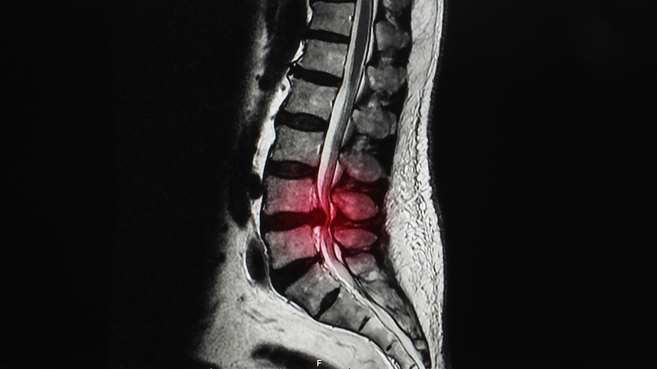Nguyên nhân đau lưng dưới cũng có thể vì bị hẹp cột sống